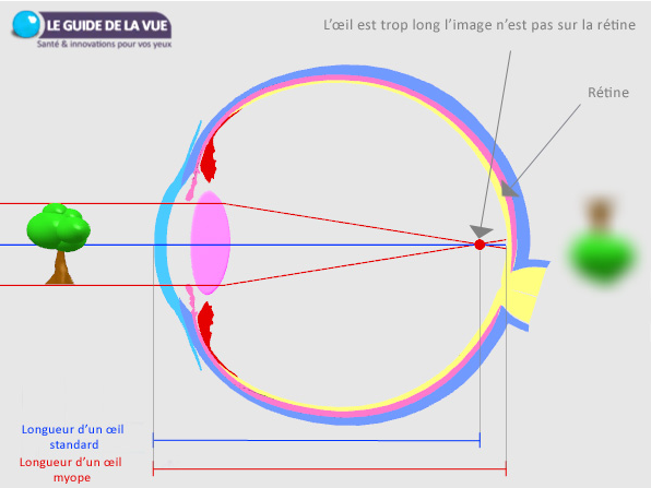 Schéma de l’œil myope